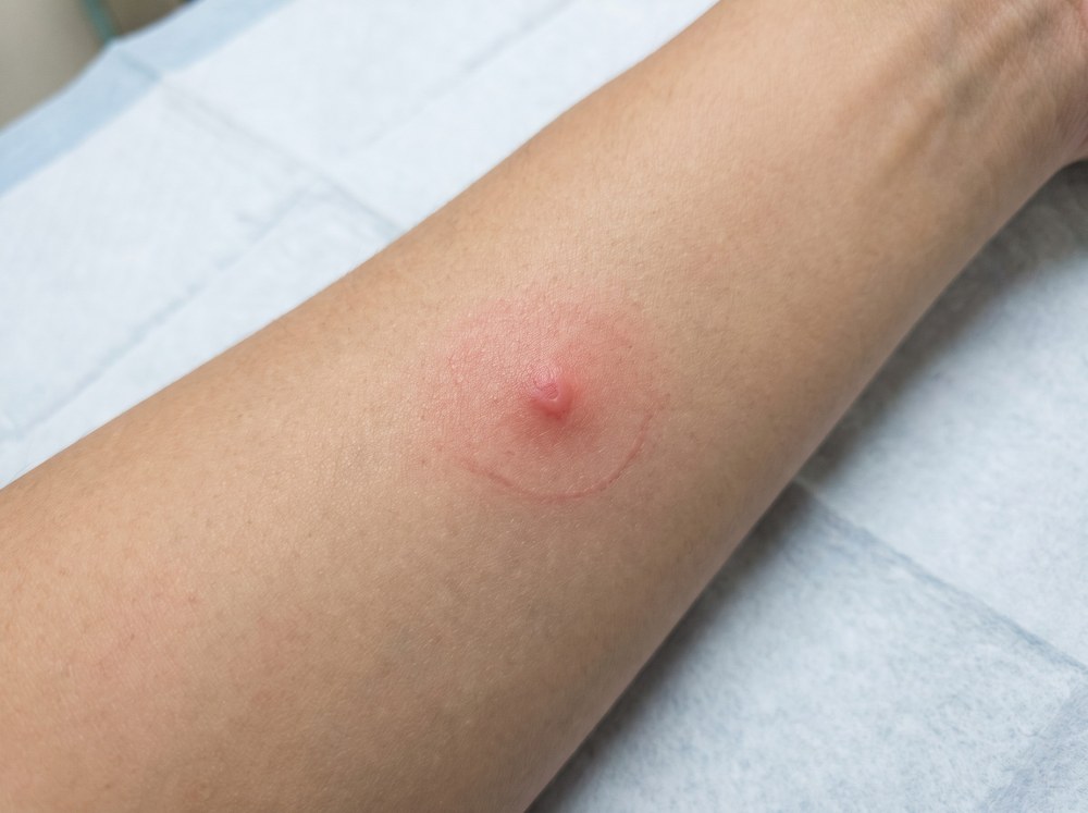 Close-up of mild red skin irritation with slight swelling where a shield bug's defensive secretion contacted bare skin