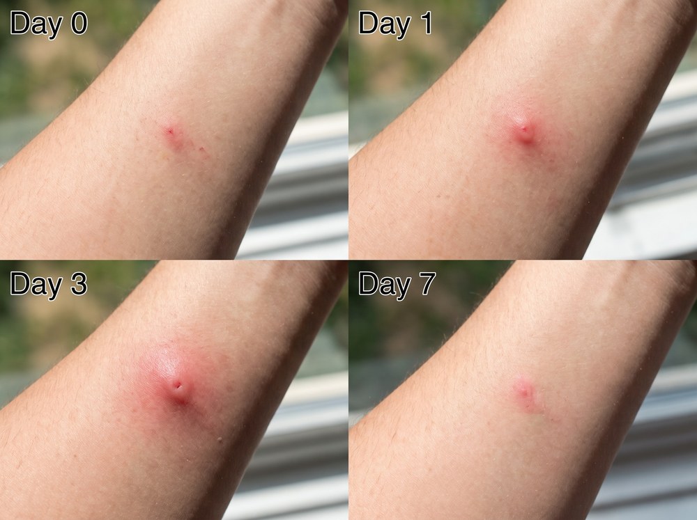 Four panel progression photograph showing mild skin irritation fading from day zero through day seven back to normal skin